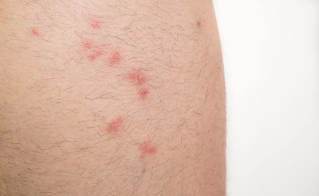 A closeup of flea bites on a human leg