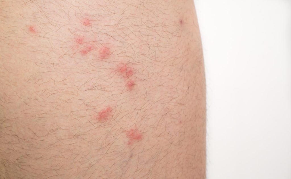 Flea bites on a leg.